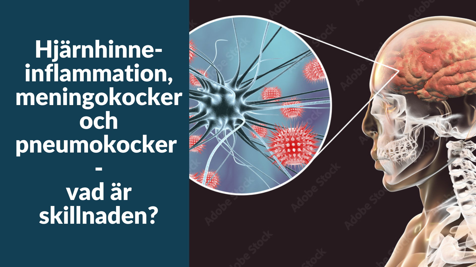 Hjärnhinneinflammation, meningokocker och pneumokocker – vad är skillnaden?